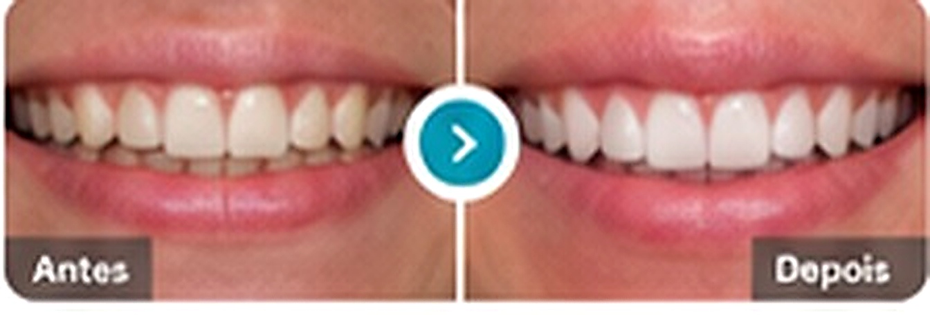 Antes e depois de clareamento dental