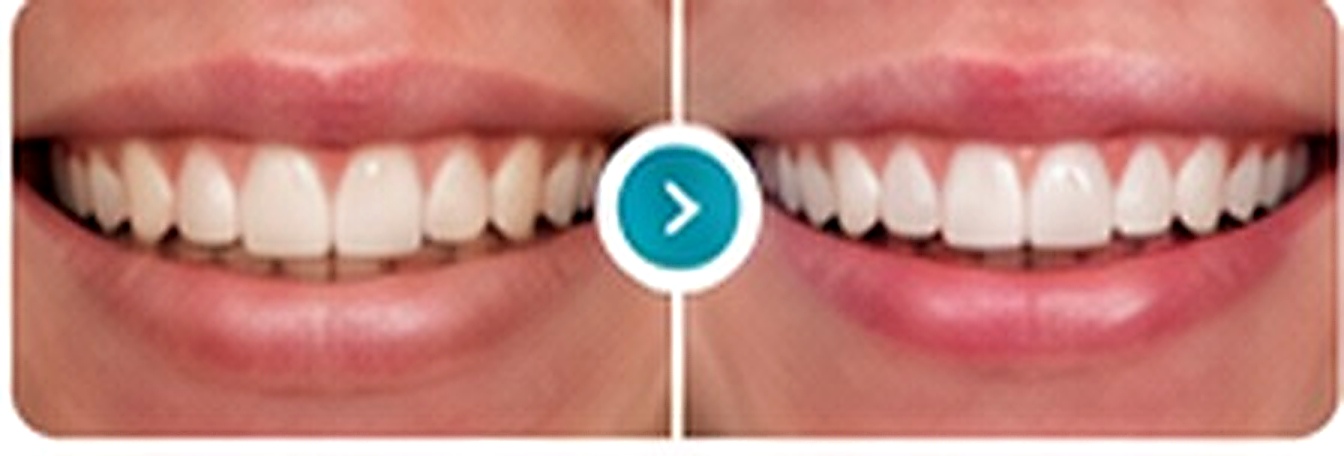 Antes e depois de facetas dent&aacute;rias