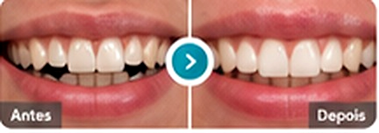 Antes e depois de reabilita&ccedil;&atilde;o oral