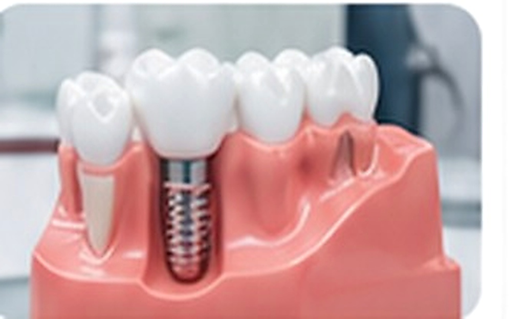 Tecnologia para implantes odontol&oacute;gicos
